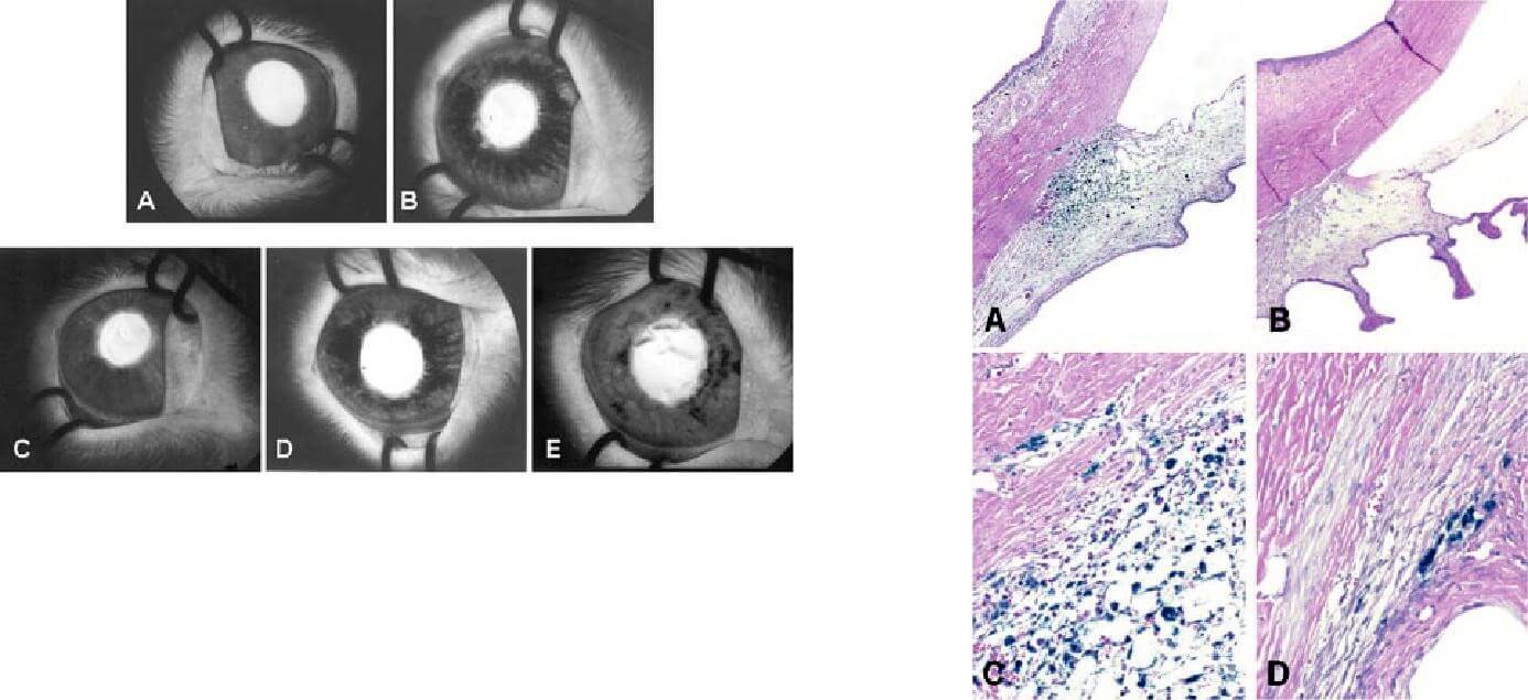 Conjunctivitis surgery